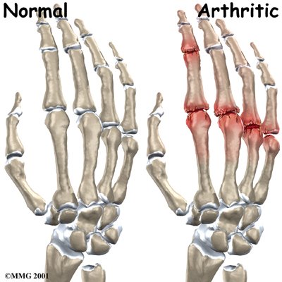 Arthritis Pain